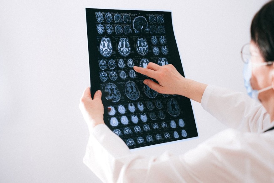 Experts Spot Something Different About Brains of People With Autism